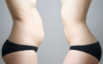 Liposuction and Body Contouring