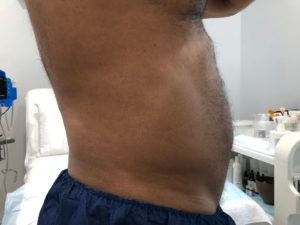 Male Liposuction BEFORE