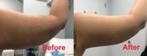 right Arm lipo before 650x1024 190x300 1